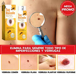 Eliminador de verrugas