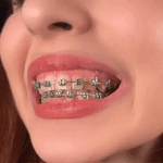 Irrigador Dental 4 Boquilla