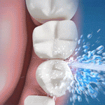 Irrigador Dental 4 Boquilla